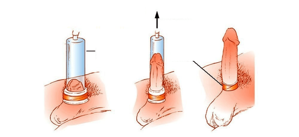 come funziona una pompa a vuoto per l'ingrandimento del pene