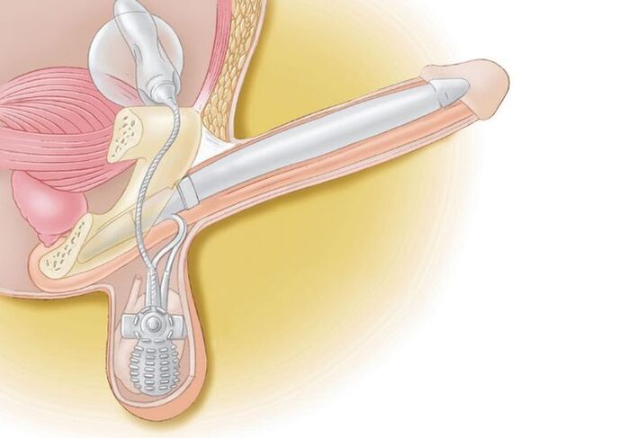 protesi peniene per l'allargamento